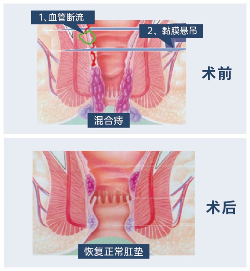 EPH痔疮手术术前术后.jpg